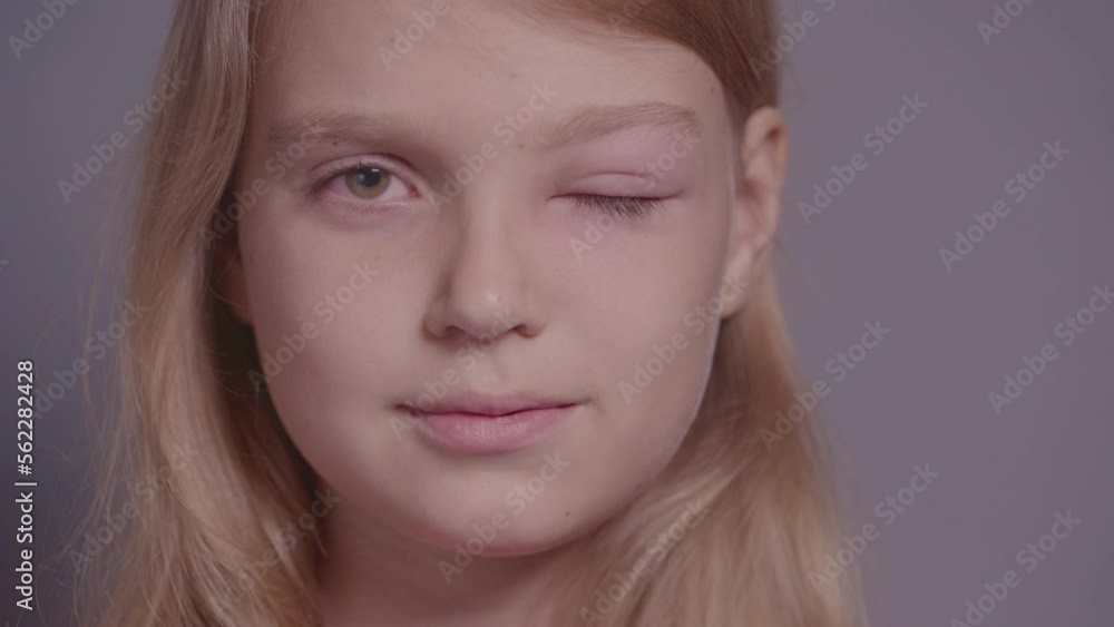 Close-up of a teen girl with a swollen and inflamed eye looks at the camera. The sad expression of the face is replaced by a happy smile. Close-up of a teen girl with a swollen and inflamed eye looks at the camera. The sad expression of the face is replaced by a happy smile.