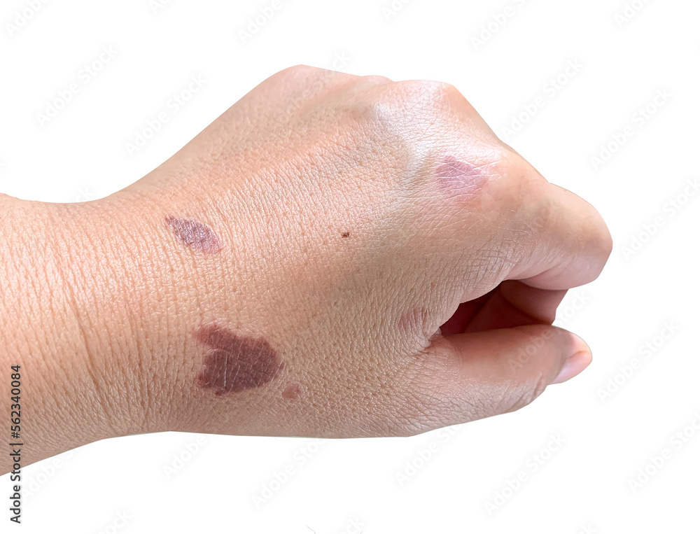Fototapeta premium wounds from cooking oil splashed on hands, on white background, isolated