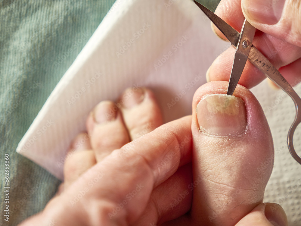 The nail cavity is cleaned with scissors. Treatment of fungal nail diseases. The nail cavity is cleaned with scissors. Treatment of fungal nail diseases.