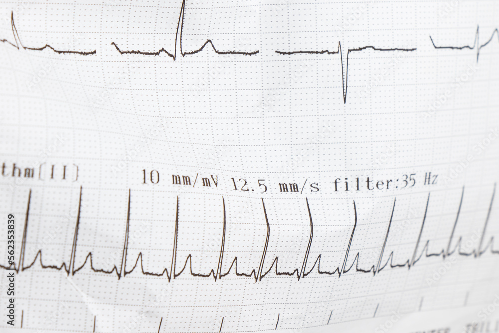 Cardiogram, waves of heart beat, EKG on the paper