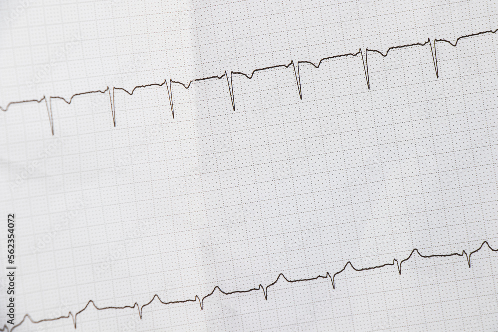 Cardiogram, waves of heart beat, EKG on the paper Cardiogram, waves of heart beat, EKG on the paper
