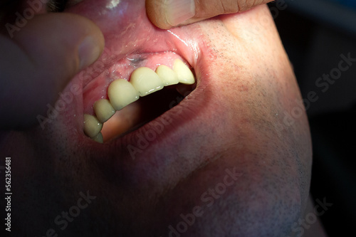 Zirconium metal-free ceramic crowns in the patient's mouth. photo