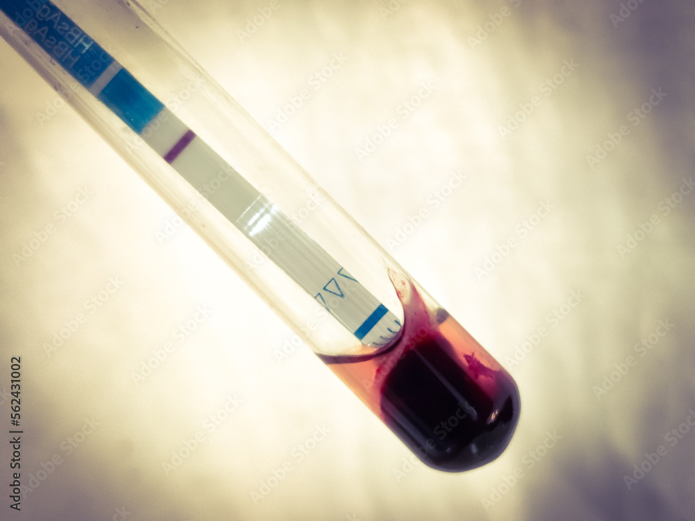 HBsAg Test Medical check up test, with whole blood sample and testing