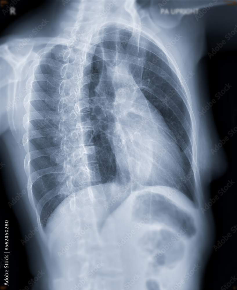 Chest x-ray image oblique view for screening diagnosis TB,tuberculosis and covid-19. Chest x-ray image oblique view for screening diagnosis TB,tuberculosis and covid-19.