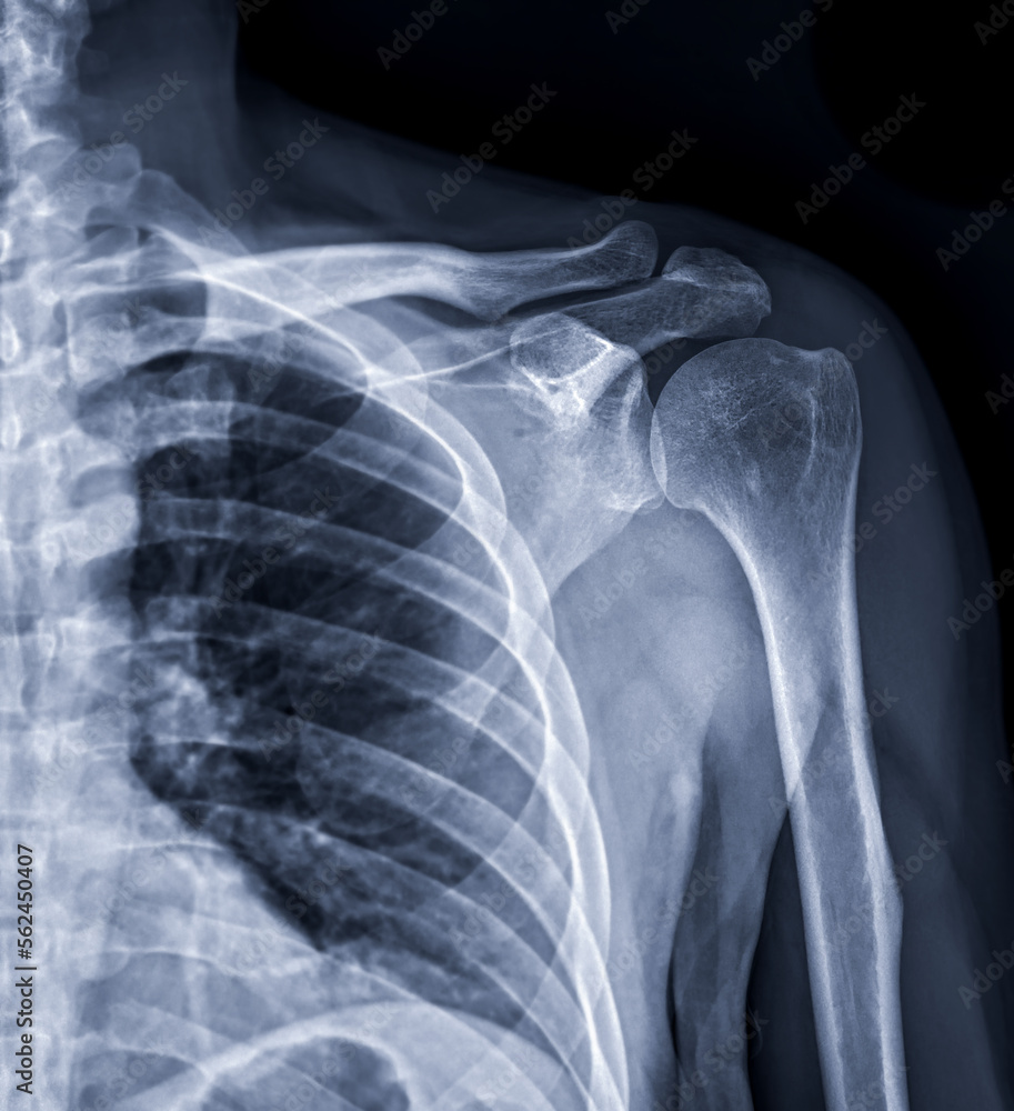 Xray of Shoulder joint for diagnosis shoulder joint from dislocation