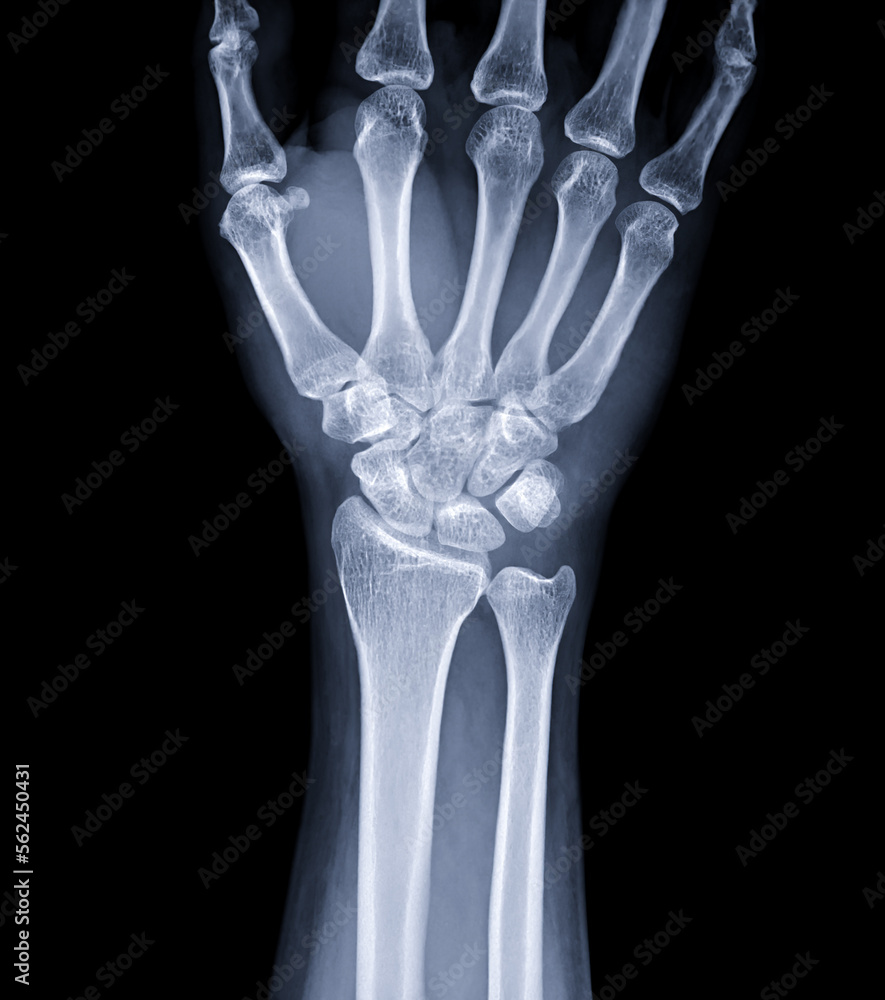X-ray image of wrist joint for diagnosis rheumatoid arthritis . X-ray image of wrist joint for diagnosis rheumatoid arthritis .