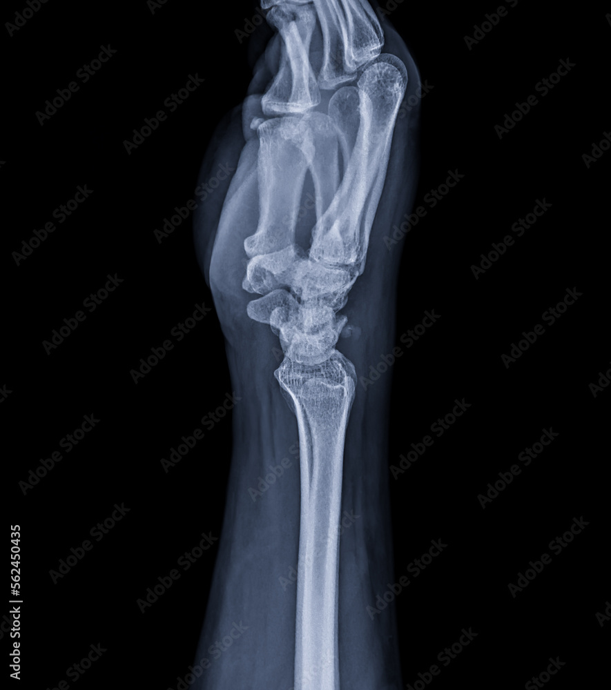 X-ray image of wrist joint for diagnosis rheumatoid arthritis .