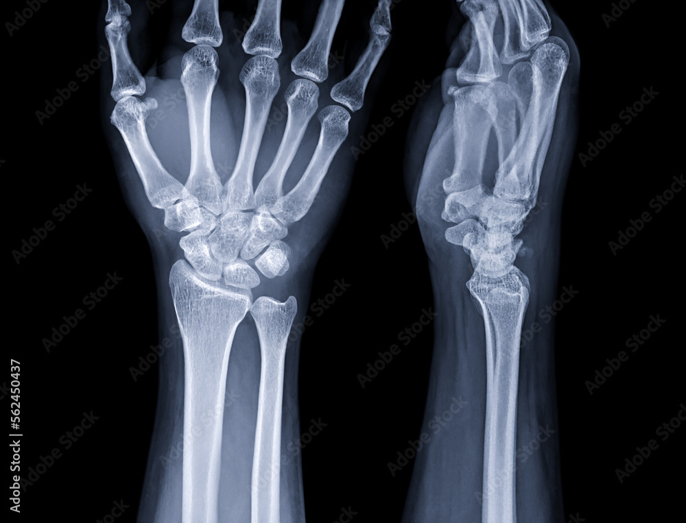 X-ray image of wrist joint for diagnosis rheumatoid arthritis . X-ray image of wrist joint for diagnosis rheumatoid arthritis .