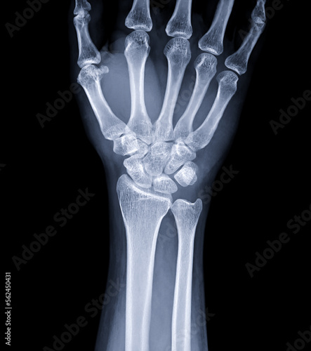 Obraz na plátně X-ray image of wrist joint for diagnosis rheumatoid arthritis .