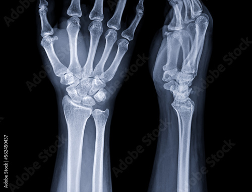 X-ray image of wrist joint for diagnosis rheumatoid arthritis . photo