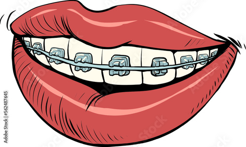 The bright red lips of the girl are slightly parted, a beautiful white smile with braces is visible. Self care and beauty.