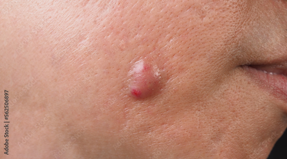 Fototapeta premium Bacterial skin infection. Big Acne Cyst Abscess or Ulcer Swollen area within face skin tissue. Containing accumulation of pus and blood. Macro shot of Acne or Dermatitis near mouth on face. Skincare.