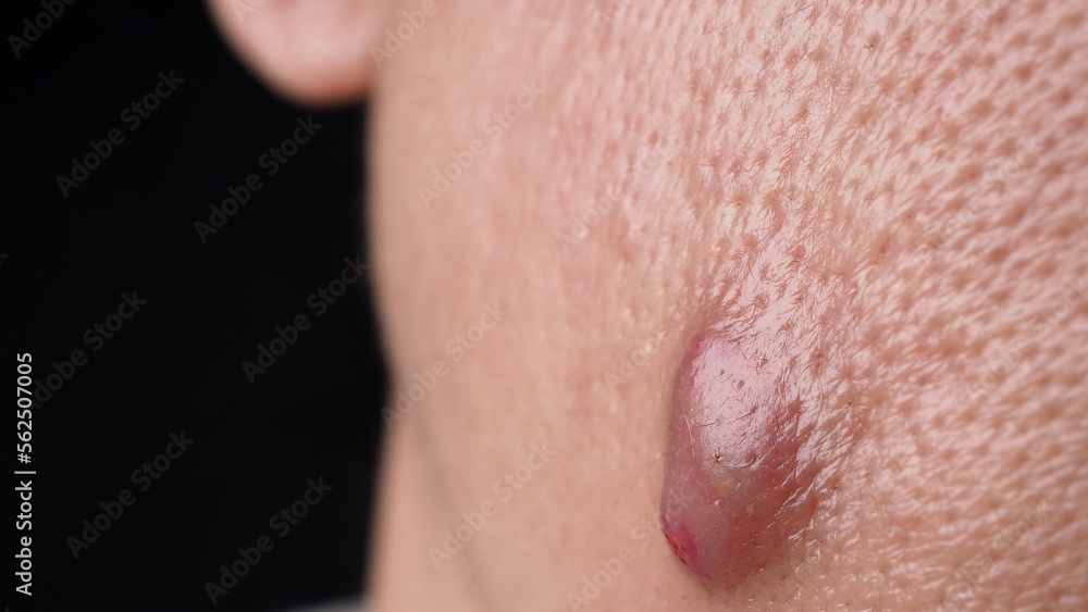 Fototapeta premium Bacterial skin infection. Big Acne Cyst Abscess or Ulcer Swollen area within face skin tissue. Containing accumulation of pus and blood. Macro shot of Acne or Dermatitis near mouth on face. Skincare.