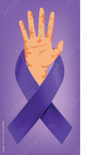 janeiro roxo, mes de prevenção a hanseniase, hanseniase, janeiro roxo hanseniase, mes de conscientização a hanseniase, lepra , janeiro, roxo, 