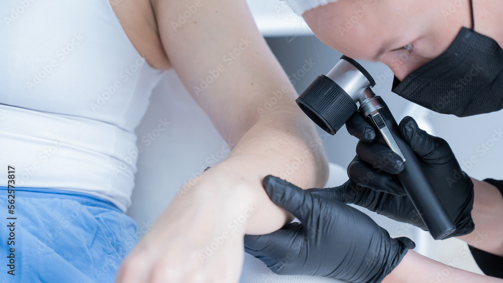 A dermatologist examines a patient's mole through a dermatoscope. 