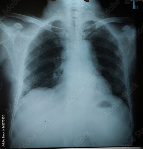 Normal chest x-ray