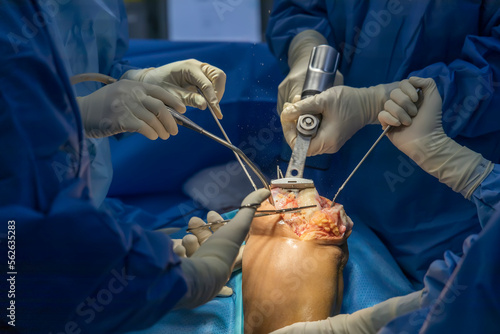 Team of doctor perform total knee replacement surgery in osteoarthritis patient inside the operating room. Selective focus at oscillating saw thar cutting the bone.Close up photo.Medical concept. photo