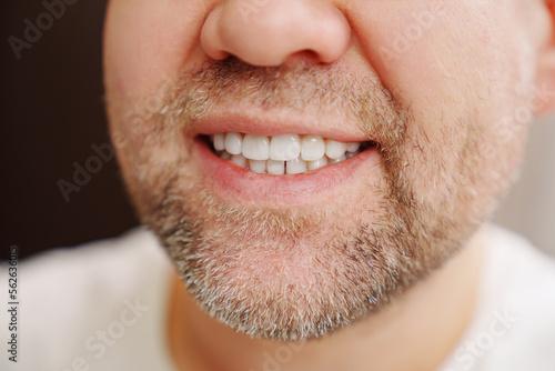 close-up. the man's mouth with stubble smiles and shows white teeth. the concept of dental services, whitening and veneers.