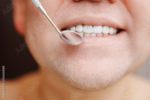 close-up. examination of teeth with veneers with a special dental mirror. the concept of dental and oral hygiene.