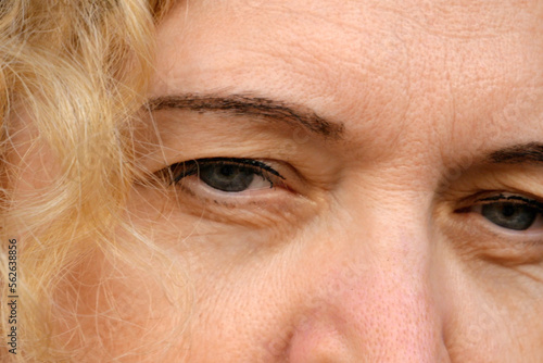 middle aged female's eye with drooping eyelid . Ptosis is a drooping of the upper eyelid, lazy eye. Cosmetology and facial concept, first wrinkles