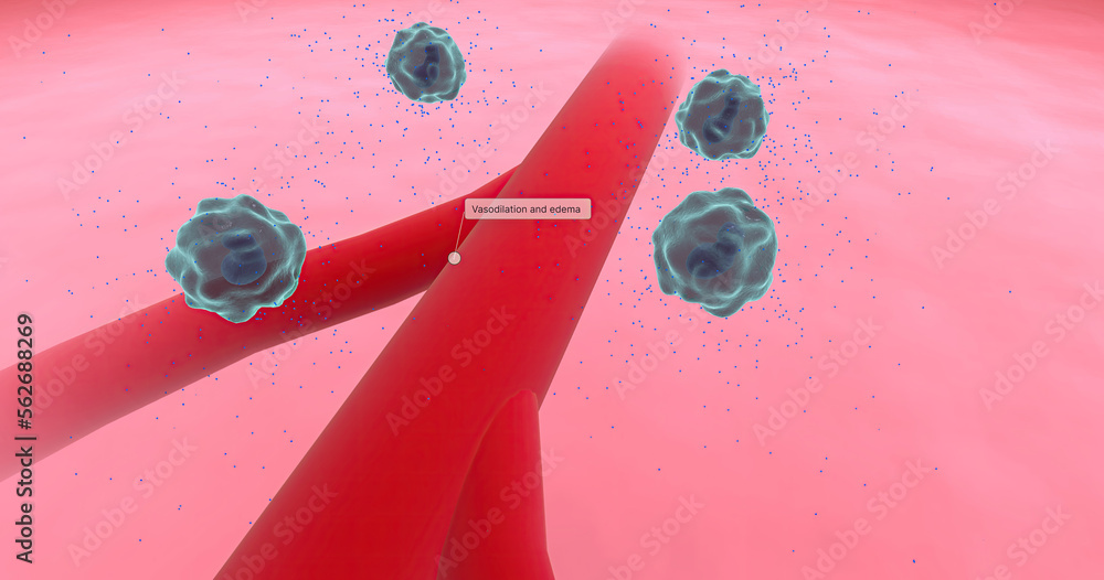 Anaphylaxis, Histamine Release and Vascular Edema Stock Illustration
