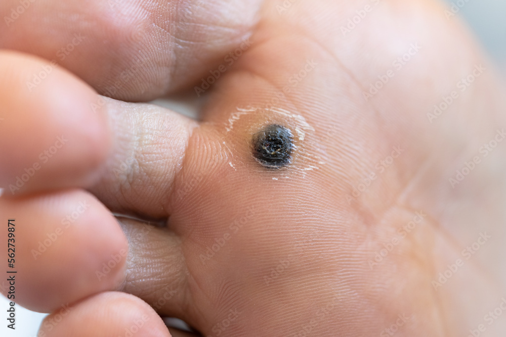 Closeup of dead skin around wart plantar after cauterizing it with celandine on infected foot. Hygiene, human skin disease, papillomavirus or HPV concept. Self-medication. Closeup of dead skin around wart plantar after cauterizing it with celandine on infected foot. Hygiene, human skin disease, papillomavirus or HPV concept. Self-medication.