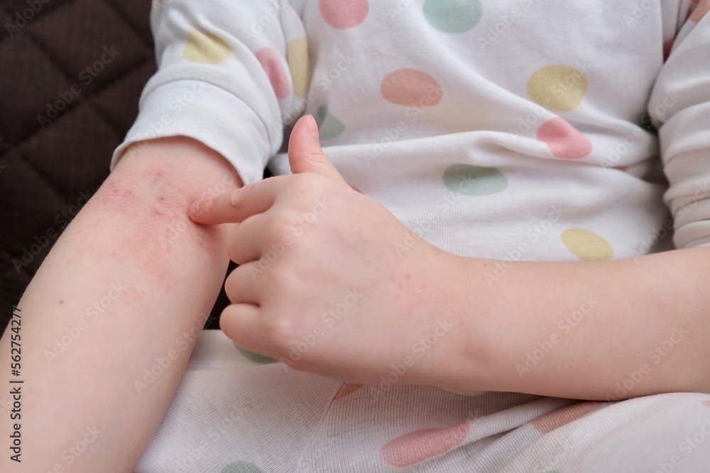 The child scratches atopic skin. The child applies a special cream to atopic skin. Dermatitis, diathesis, allergy on the child's body. The child scratches atopic skin. The child applies a special cream to atopic skin. Dermatitis, diathesis, allergy on the child's body.