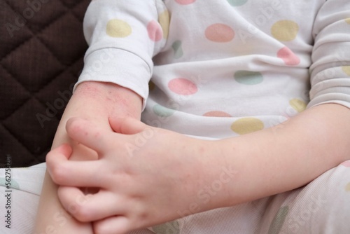 The child scratches atopic skin. The child applies a special cream to atopic skin. Dermatitis, diathesis, allergy on the child's body.	