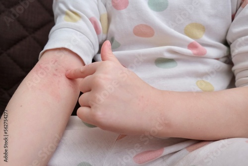 The child scratches atopic skin. The child applies a special cream to atopic skin. Dermatitis, diathesis, allergy on the child's body. 