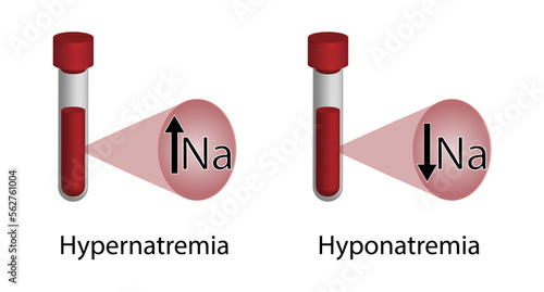 Hypernatremia, high plasma sodium level and Hyponatremia, low plasma sodium level. Sodium Na excess and deficit electrolyte disorders, blood test tube, Scientific design. Vector illustration.