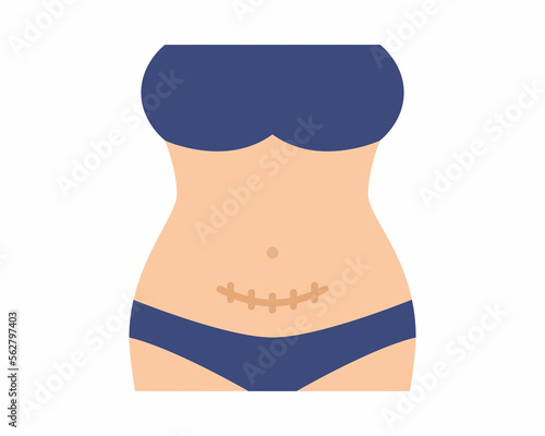 Woman Showing Belly with in Cesarean Wound