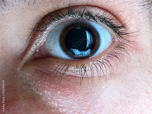 Close-up of a man's brown eye with dilated big pupil. Eye drops after a visit to an ophthalmologist. Concept of healthy vision. Ophthalmological examination and treatment.