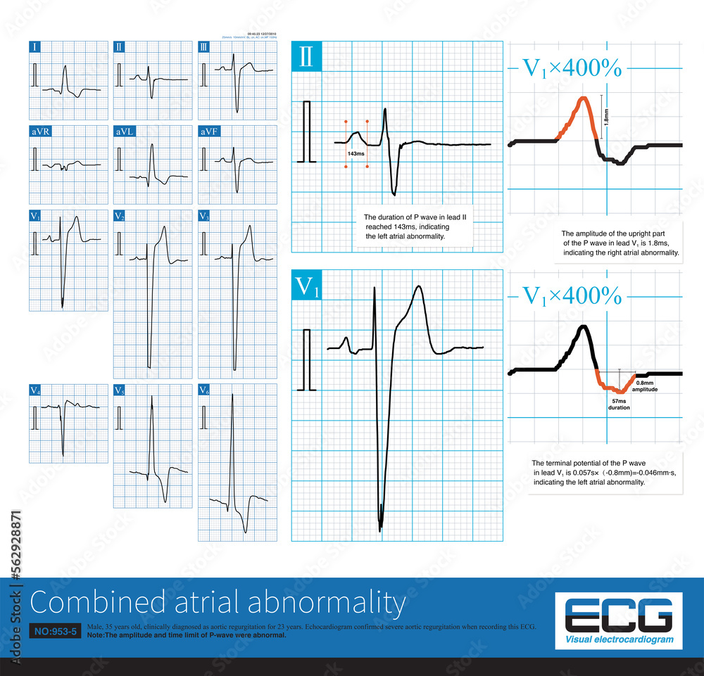 Sometimes, we can use lead V1 to measure the interval and amplitude of P wave, and simultaneously diagnose left atrial abnormality and right atrial abnormality, that is, biatrial abnormality.