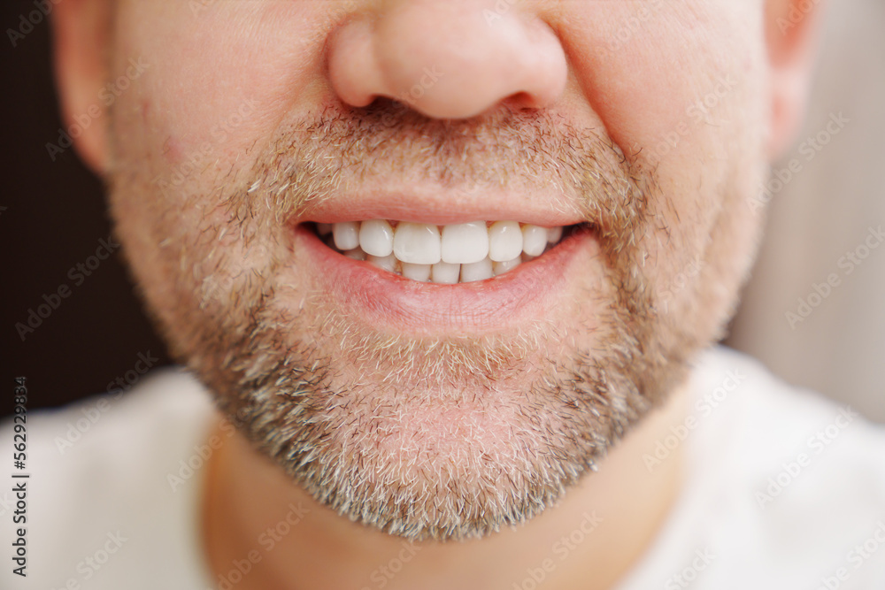 Fototapeta premium close-up. the man's mouth with stubble smiles and shows white teeth. the concept of dental services, whitening and veneers.