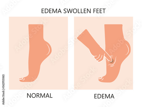 Meige’s syndrome Milroy Leg edema venous Deep vein cancer swelling upper limb wrap calf ulcer meige lymph node arms hand pain cloth blood feet ankle liver kidney heart lung non Nonpitting pedal