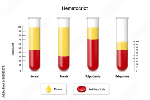Blood analysis. Hematocrict. Normal, Anemia Polycythemia and Dehydration.