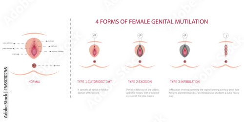 Infographics of the 4 types of female genital mutilation on a white background photo