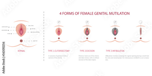 Infographics of the 4 types of female genital mutilation on a white background