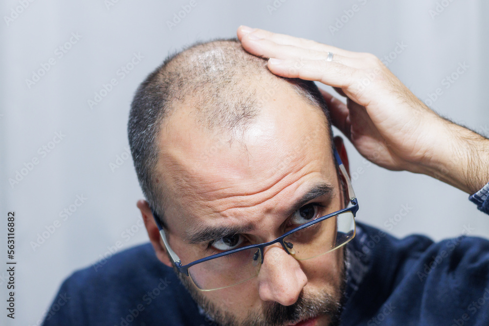 Fototapeta premium Young man with alopecia looking at his head and hair in the mirror