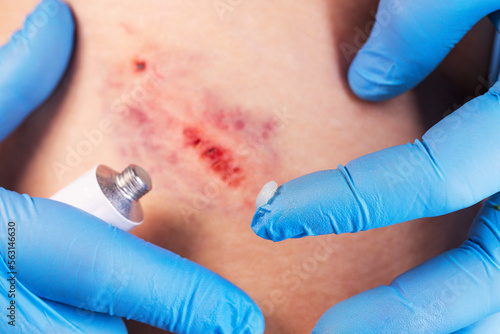 Obraz na plátně Doctors hands apply medicinal ointment to the bruise on the patients body