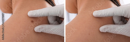 Collage with photos of patient's back before and after mole removing procedure, closeup. Dermatologist checking woman's skin