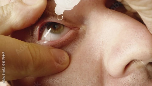 Person instills hydrating drops from vial into eyes for moisturizing after work on computer. Man opens eye wide with fingers extreme closeup photo