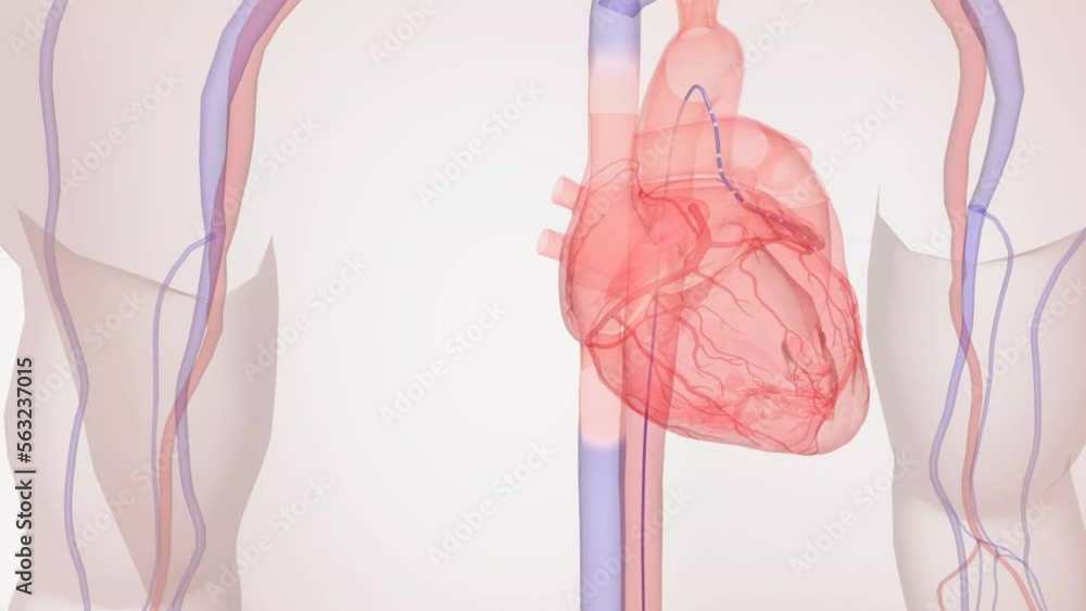 Using a local anesthetic, a catheter is inserted into a vein or artery near the groin. Stock 비디오