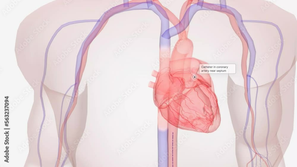 Using a local anesthetic, a catheter is inserted into a vein or artery