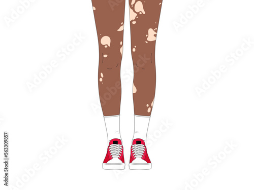 Vector vitiligo skin illustration. Beautiful vitiligo black girl legs isolated on white background. Skin diseases problem poster. Black skin pale spotted. Woman skin pigmentation. Afro american feet photo