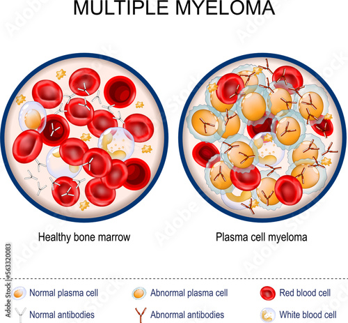 Multiple myeloma. Close-up of Healthy bone marrow and Plasma cell myeloma.
