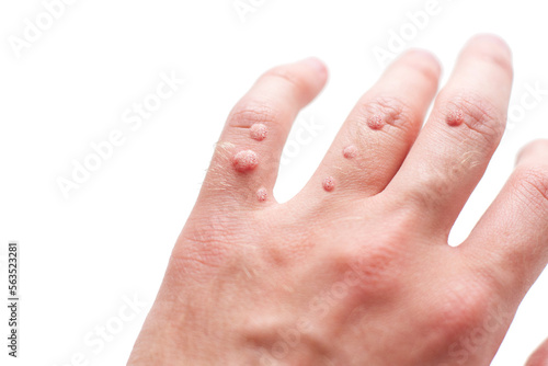 A lots of Viral warts on hand