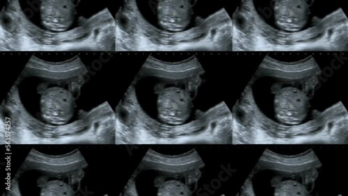 Multi screen ultrasound small baby at 12 weeks. 12 weeks pregnant ultrasound image show baby or fetus development and pregnancy health checking photo