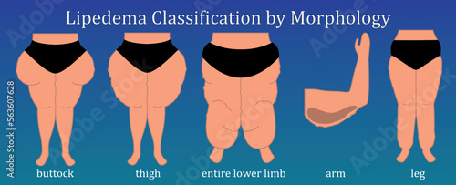 Lipedema classification by morphology. Obesity types