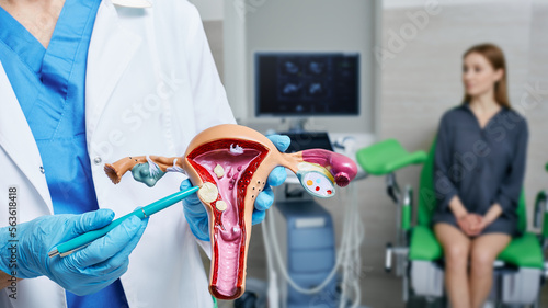 Uterine fibroid, myoma. Gynecologist pointing uterine leiomyomas on anatomical model of uterus while female patient's gynecological consultation photo